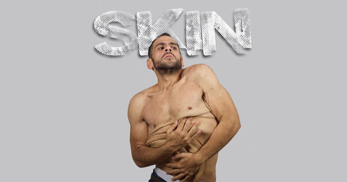 ‘Skin’ Is A Sensitive Telling Of Body Image Issue Dealt With Humour By A Delightful Gay Couple!
